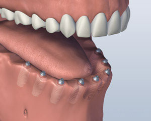 After Dental Implants Placed